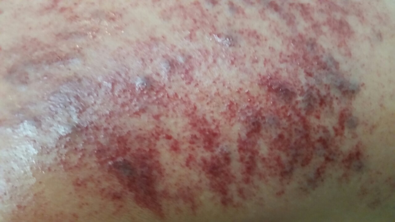 캠페인 썸네일