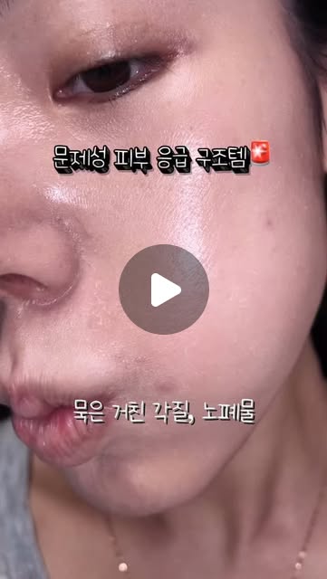 (모공, 각질, 흔적)피부과 관리를💉이제 집에서?🏠
닥터노바메디 더마스파인 리바이벌 테라피 @dr.novamedi
넓은 모공, 여드름 자국, 색소침착, 잔주름..
저같은 총체적 문제성 피부이신 분들!!
피부과 가서 아무리 관리받아도 그 때 분이고 돈 너무 부담되잖아요..🥹
실제 대한민국 서울 강남 봉봉피부과 성형외과 · 박성수 원장 직접 개발하시구
피부과에서도 찐으로 사용 중인 광채피부 만드는 꿀템 가져왔어요✨
모공보다 작은 초미세 '파이토좀 미세침’마사지로 묵은 각질 다 정리되고
수분 통로가 열려 유효 성분을 피부 깊숙이 전달하여 피부 안팎을 철저하게 정돈해줘요!
다음 단계 화장품 흡수율이 85%까지 치솟아 무려 3000배의 빠른 흡수력💦
스킨케어 효과 극대화로 피부가 진짜 좋아지더라구요?!
약간 따끔거리는 느낌이 드실텐데,
나노급 결정체 스피큘이 히알루론산에 감싸져 있어 통증이 강하지 않구
이런 통증은 유효성분이 흡수되는 정상적인 반응이랍니다😉
이 제품 딱 1회만 써주면,
5일 동안 매끈하고 깐달걀같은 피부 광채 미쳤어요..👍🏻
넓은 모공은 촘촘하고 매끄러워지고
여드름 및 자국들은 빠르게 옅어지고
잔주름이 쫙 펴지면서 탱탱하고 탄력있는 피부로!
✔️4% 유사 뱀독 펩타이드 40,000ppm + Argireline® →눈가, 팔자 주름 개선
✔️DERMA-CLERA™ ,ppm 항염 특허 → 붉은기 진정
✔️5중 세라마이드 → 장벽 강화
✔️SEPICALM VG 미백 û허 + 나이아신아 마이드 20,000ppm + 알부틴→ 잡티 케어
✔️엑소좀 + 리포좀 20,000ppm→ 탄력 개선
저처럼 거친 각질, 노폐물로 화장품이 피부 겉에서 겉돌고 맴도시는분들
피부과 가지마시구 이 제품으로 꼭 케어해보세요!!🙏🏻
#닥터노바메디 #더마스파인리바이벌테라피 #봉봉안티에이징센터 #모공관리 #트러블
