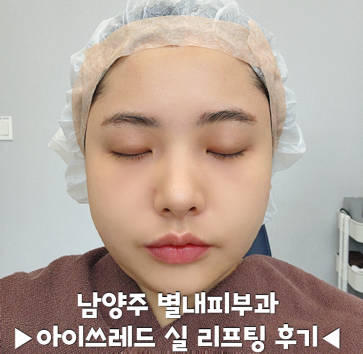 남양주 별내피부과 아이쓰레드 실 리프팅​ 후기