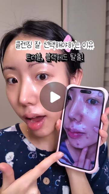 클렌징 하나 바꿨는데 트러블, 블랙헤드 탈출🔥
메디섹션넘버 M 맑은 결 클렌징 오일 @medi_section 

트러블 피부는 화장하면 더 답답하고
가리려고 바르면 바를수록 더 이상해지고..
트러블, 모공때문에 진짜 고민이었거든요 ㅠㅠ

트러블 지성피부는 무겁고 미끄덩한 오일은 꺼려지는데,
이 오일은 진짜 물처럼 가볍고 부담 전혀 없어요!

메이크업부터 피지, 블랙헤드까지 싹 케어해줘서
피부 자체가 넘 좋아져서 화장 너무 잘 먹는 요즘👍🏻

워터프루프도 한 번에 녹고 (97.68% 세정 테스트 완료)
한 번만 써도(69.73% 세정) 피지가 그냥 녹아 나와여!!💦

피지 정리되니까 확실히 피부가 만져도 뭐 안 올라오는 느낌‼️

클렌징 오일만 바꿨을 뿐인데 차이 진짜 대박,,
여러분들도 더 늦기 전에 꼭 써보세요 :)

#메디섹션넘버M #클렌징오일 #클렌징오일추천 #솔직후기 #인생클렌징 #클렌저 #클렌저추천 #클렌징추천 #저자극클렌징 #모공청소 #모공관리 #모공케어 #블랙헤드 #피지제거 #피지관리 #피지 #데일리케어 #스킨케어루틴 #뷰스타그램