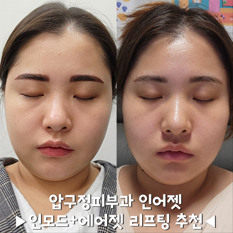 압구정피부과 인어젯(인모드+에어젯)리프팅 추천
