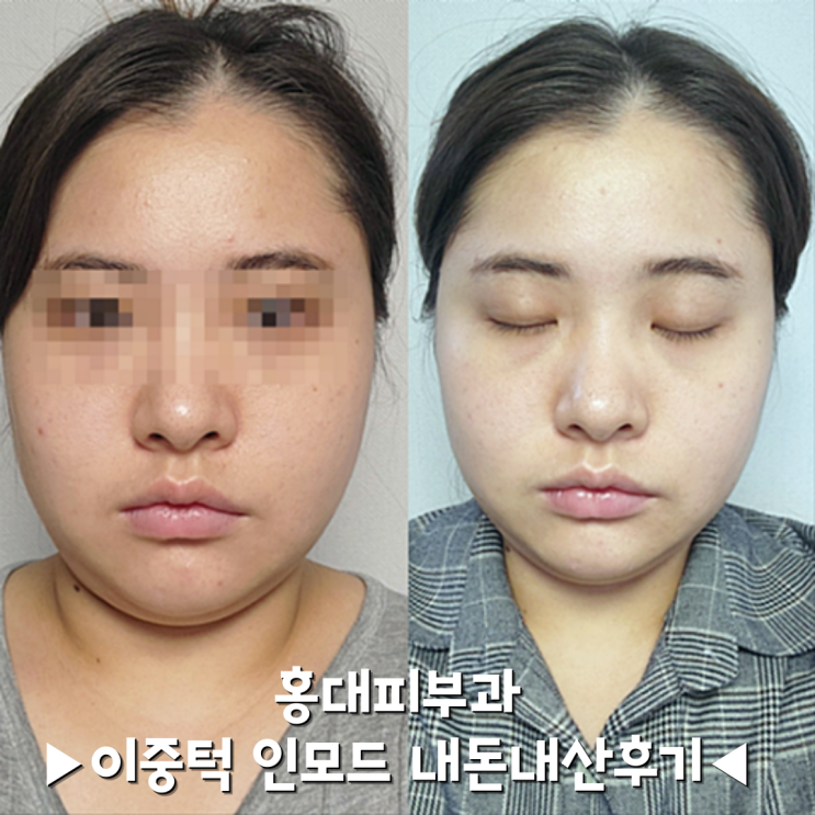 홍대 피부과 내돈내산 이중턱리프팅 인모드FX 윤곽주사 후기