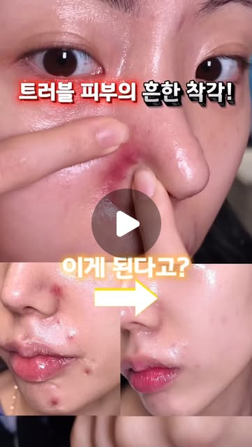 뭘 해도 트러블 흔적 안 없어지는 이유?🥵
💛메디테라피 흔적 스킨부스터 듀오
@meditherapy.co.kr
트러블 피부들의 흔한 착각..
트러블 나면 최대한 기초 안 발라야 한다?❌
제대로 비워내지 않고 올리기만 하면
피부는 피지를 더 뿜어내고, 모공이 막히면서
염증이 반복돼서 흔적이 더 오래가는거예요!
⭐️point 제대로 비워주는 것⭐️
레티날 세럼으로 모공에 쌓인 각질 싹 비워주니까
트러블은 줄고 착색도 옅어졌어요🥺
부드러운 턴오버로 피부톤도 밝아지는 느낌!
그 다음은 꼭 트라넥크림으로 깊은 뿌리부터 환하게 만들어 주기
피부 속 멜라닌까지 흔적 집중 개선시켜줘서
흔적 고민이면 필수템‼️
이것저것 잔뜩 발랐을 때보다
딱 이 두 개만 썼을 때 효과가 진짜 보였답니다!
저처럼 트러블, 흔적 고민이면
꼭 이거 두 개는 무조건 같이 써보세요ㅠㅠ!!!
#메디테라피 #흔적듀오 #피부관리 #흔적케어#레티날 #트라넥삼산 #화잘먹 #각질 #요철#스킨케어루틴 #기초케어추천 #기초케어 #트러블흔적 #트러블 #흔적세럼 #트러블피부 #잡티 #여드름