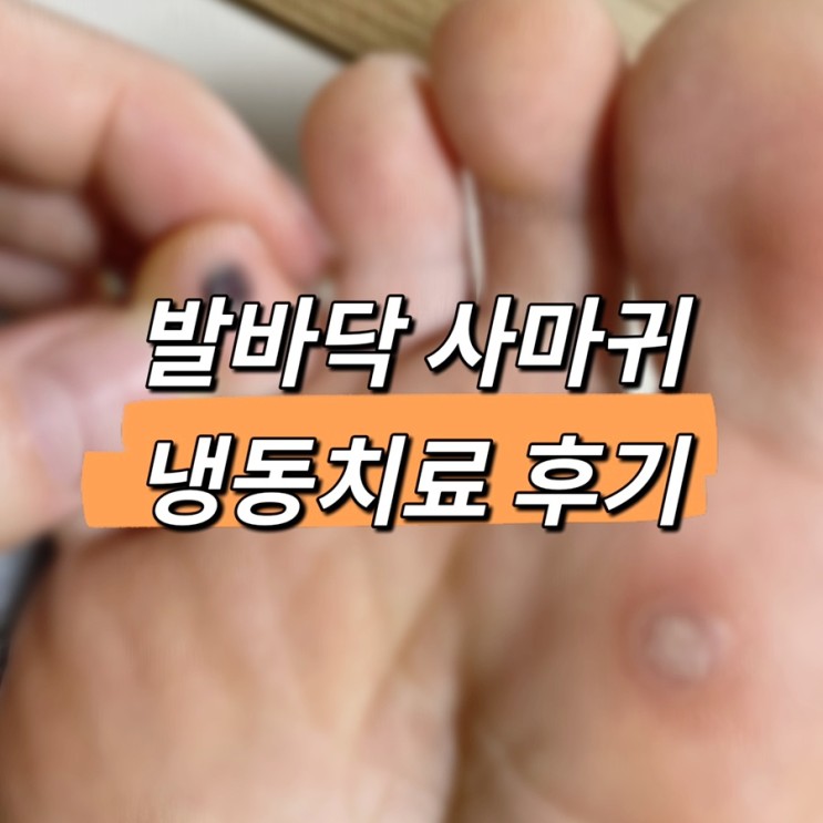 사마귀 치료 1탄 / 발바닥 족저사마귀 내돈내산 피부과 냉동치료, 와트프리져 후기(+ 셀프치료과정)