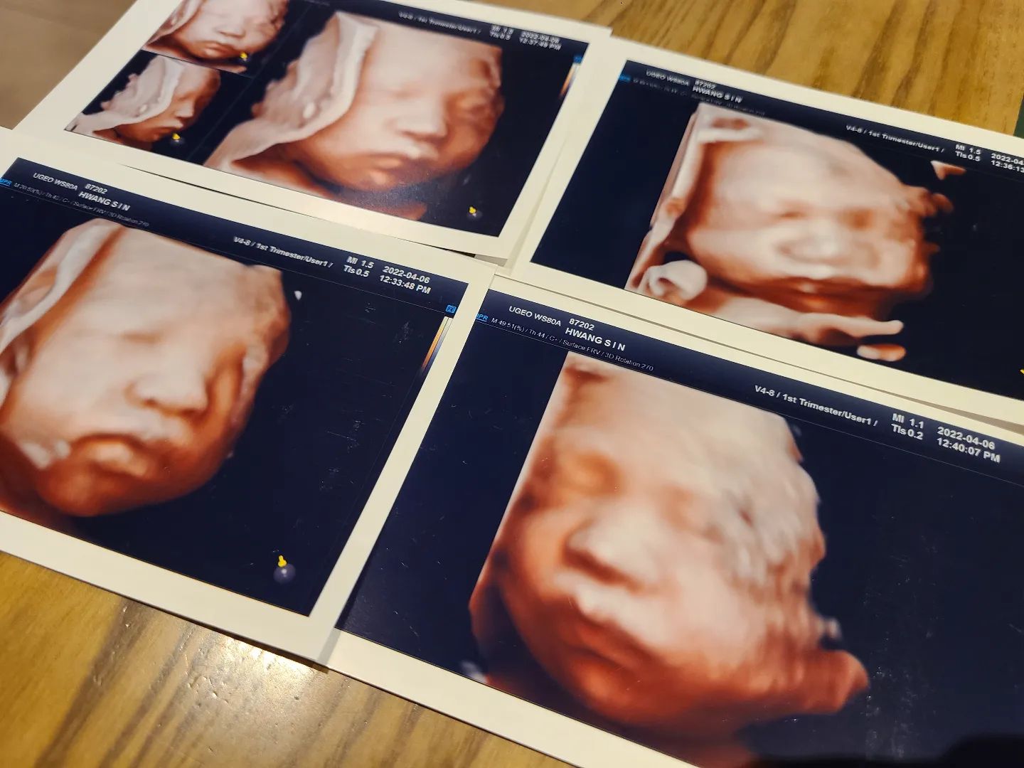 #입체초음파
.
이제와서 
.
#임밍아웃🤰🏻 
28주에 찍었어야 했는데
부끄럼쟁이 
얼굴안보여주다가
뒤늦게 30주에 겨우 찍어봄
.
준이랑 닮은것같기도 하고
아닌것같기도 하고
오동통하니 살이 올라서
삐진것처럼 입술 삐죽 
.
이제 진짜 얼마안남았는데
무얼하며 의미있게 보낼꼬?
.
.
.
#둘째 #임밍아웃 #애둘맘
#호랑이띠맘 #입체초음파사진 
#초음파사진 #BUTTER #임산부스타그램
