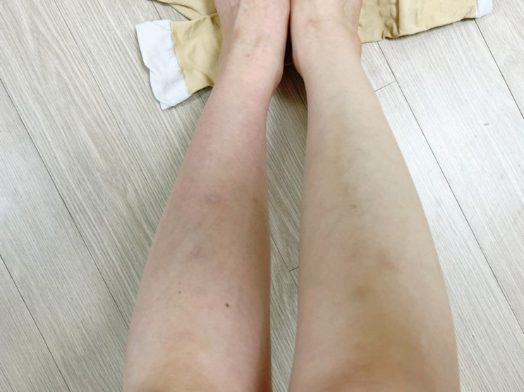종아리압박밴드 : 다리붓기 관리에는 네이키드오얼드레스드