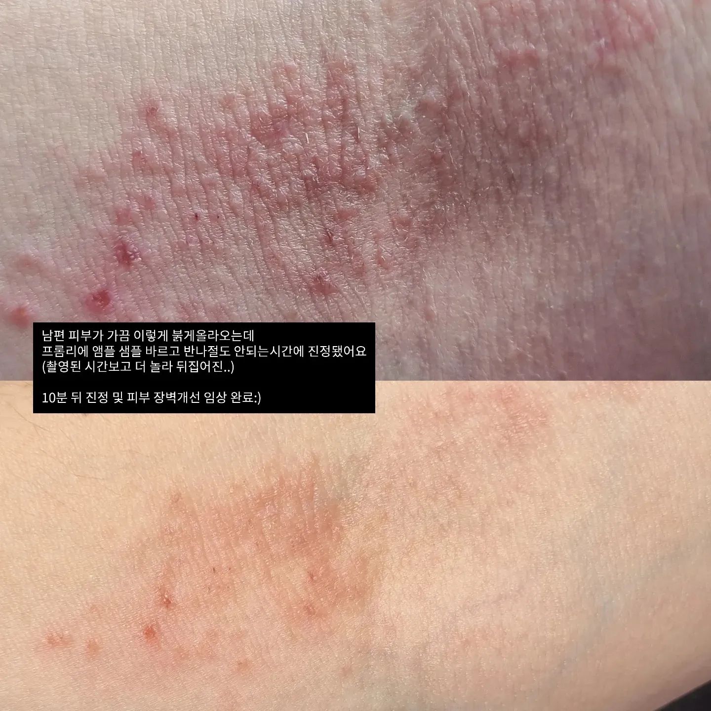 2년 동안 정말 오래 준비했던
민감 수부지 구원 브랜드 프롬리에
드디어 런칭일자가 잡혔습니다!

항상 의문이었어요 브랜드에서 다들 순하다고 광고하는데
그리고 임상도 0.00인데 왜 나는 트러블이 날까?
연구원님들이 놀랄정도로 제가 정말 1% 극 미량 성분 변화에도 트러블이 일어나는
극극 민감성 피부였더라구요.. 이정도면 피부 장금이 아니나며,,
(대장금 아세요? 나이 들통남🥲)

민감성 수부지인 제가 민감성 수부지 라인만 죽어라 공부했습니다.

1️⃣ 민감성 수부지들은 유분이 넘쳐서도, 수분이 부족해서도 안되는
정말 수분과 유분의 미묘한 밸런스를 잘 맞춰줘야 트러블이 안나요!

그냥 지성 피부는 유분만 적게 들어가면
어느정도 커버가 되는데 반면에,
민감성 수부지는 수분까지 부족하기 때문에
그 트러블이 나지 않는 미묘한 밸런스를 맞춰야해요!

2️⃣ 그리고 진짜 저처럼 민감하신 분들은
오히려 고함량 제품이 더 트러블이 많이 날수가 있습니다.
또 이게 다 제품, 제형, 조합마다 달라요...
저는 토너는 어성초 80% 함량인 토너 잘쓰는데
앰플이랑 크림에 어성초 80% 넣겠다고 시도했다가
증말 얼굴에 트러블나서 진정시키는데 몇주 걸렸답니다..

3️⃣ 어성초 추출물도 원산지 별로, 원료사 별로 여러가지인거 아세요?
연구원님들,, 저 때문에 진짜 고생하셨어요..
어성초 추출물 테스트만 10가지 넘게 했던것 같아요.

마지막에 진짜 제가 만족할만한 제형감과, 영양감
그리고 무엇보다 트러블이 더 이상 나지 않는
어성초 추출물을 셀렉해서 완성했답니다..!
(2년 걸릴만 하쥬?ㅠㅠ)
앰플에는 어성초 추출물이 약 50%가 들어가 있습니다.

5️⃣ 저희 임상도 다 받았는데요-!
저자극 임상은 물론
바른 뒤 10분만에 진정, 피부 장벽개선 효과까지 입증되었어요!

첫번째 사진이 5월 쯤인데, 
남편이랑 신혼여행갔다가 급 트러블이 올라와서
그때 버스에서 저희 샘플밖에 없어서 발라줬는데
반나절도 안되는 시간만에 진정이 되어서 둘다 진짜 놀랐답니다!!!!
저때 샘플에서 더 개선해서 지금 런칭되는 제품은 보습력, 진정력 더 좋아졌어요!

6️⃣ 양산 직전까지 제조사 만류에도 불구하고 또 수정하고 또 수정해서
런칭일자가 많이 미뤄졌지만
그래도 제가 만족하지 못하는 제품을 출시할 순 없었어요ㅠㅠ

단상자랑 봉합스티커 하나까지도
절대 타협하지 않으며 제작한 브랜드가
10월 26일 세상에 나옵니다!

진짜 샘플링하면서 제가 너무 칼같이 돌려보내고
다시 뒤집고를 반복하면서 저도 모르게
내가 영원히 만족하지 못하는건 아닌지 진짜 고민 많이했어요

주변에서는 이제 그만 타협해서 제품 출시하라고,,
말리고 조언도 많이 해줬는데
진짜 눈물을 머금고 긴 시간동안 꿋꿋하게 샘플링 해왔습니다.
런칭 날에는 진짜 눈물이 날것만 같네요...(진심그잡채..)

계속 스포할게요! 기대해주세요:)

저희 12월 정도에 출시 예정인 크림도 진쫘 좋아요(미리스포포)
민감성 수부지 크림 고르기가 젤 어려운거 아시죠?ㅠㅠ