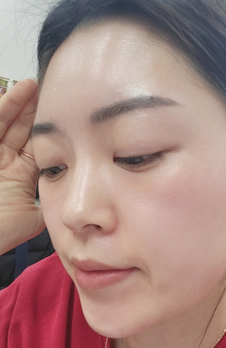 [셀프필링키트]임플란트 솔루션:품질높은 스피큘