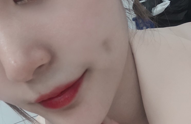 압구정 보조개 내돈주고 리얼후기!! /수술직후+2일차