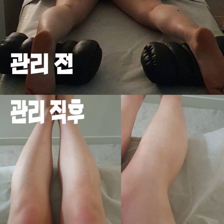 [서초동 다이어트] 하체비만 때문에 서초동 제이알 센터에서 하체관리 받은 후기