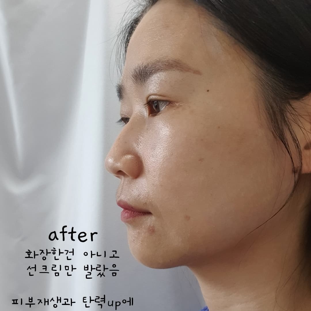 피부장벽도 무너지고
얼굴에 뭐도나고 재생도 필요해서 
.
단기간에 좋아보이는 그런 시술들 대신에 
장기적으로 피부가 더 좋아질 처방을 받고 있어요
요즘 스킨 부스터가 핫하다길래...
.
바로 효과나지않고 서서히 나는 시술이고
관리를 받을수록 좋아지는것 같음.
.
저번에는 속건조에 좋은것을 받고
았었고
이번방문엔 손상피부 재생부스터 cv엑소좀 처방.
줄기세포배양액 1,000,000 ppm 함유
참을만한 아픔이라 쫄보도 괜찮타!
.
이제껏 다녀왔던 피부과중에 젤큼!
여긴 홍대임
.
#스킨부스터 #광채시술 #잔주름개선 #mts시술 #피부과추천 #피부장벽 #트러블피부 #재생부스터 #cv엑소좀 #엘레베스스킨부스터 #엘레베스 #피부자신감엘레베스 #홍대입구피부과 #마포피부과 #홍대리엔장