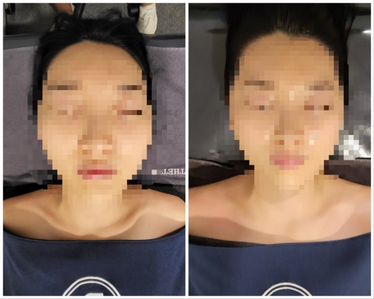 대치동 윤곽관리 찐후기 및 가격 ● 에스테티아 대치1호점  ● 대치동 피부관리 예신관리