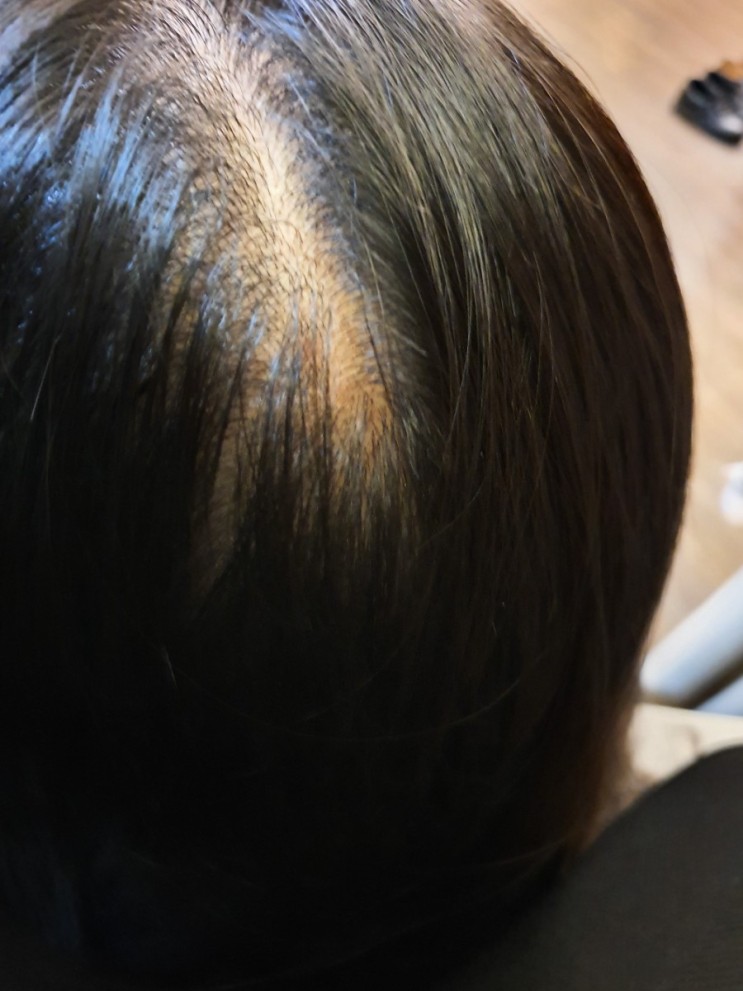 정수리 탈모, 날아가기 전에 꼭 붙잡아야 해요! 초장에 잡는 꿀 TIP