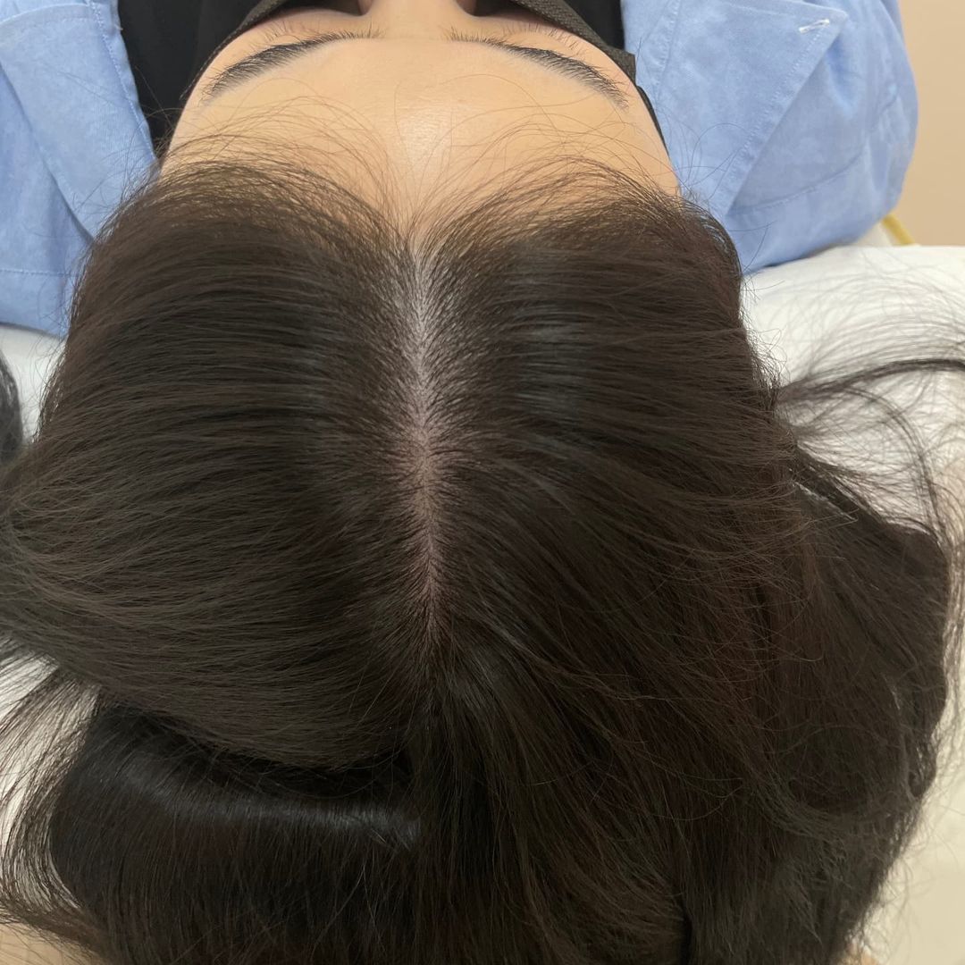 뎅볶이에 진심인편 on Instagram: “#협찬 내친구들은 알거야 스트레스로 인해 머리카락 계속 빠져서 사진찍으면 정수리 비어보여서 신경쓰인다고했던걸..☆ 이게 한번 신경쓰이면 그것만 보