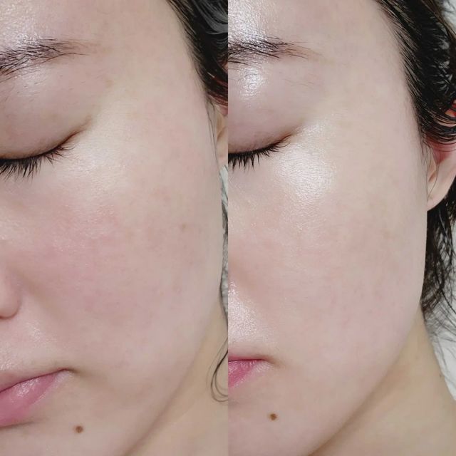 김혜영 on Instagram: "#광고 패드 한 장으로 기미, 잡티, 피부톤까지 한번에 관리를 할수있는 딥 비타C패드💛 비타민 워터가 500,000ppm이나 들어가 있어, 전성분 가장 앞쪽에 위치해 있다는👍 패