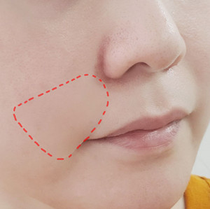 tv 예능 속 바로 그 팔자주름패치! 마르시끄 미간패치로 팔자,미간주름 동시에 케어해요