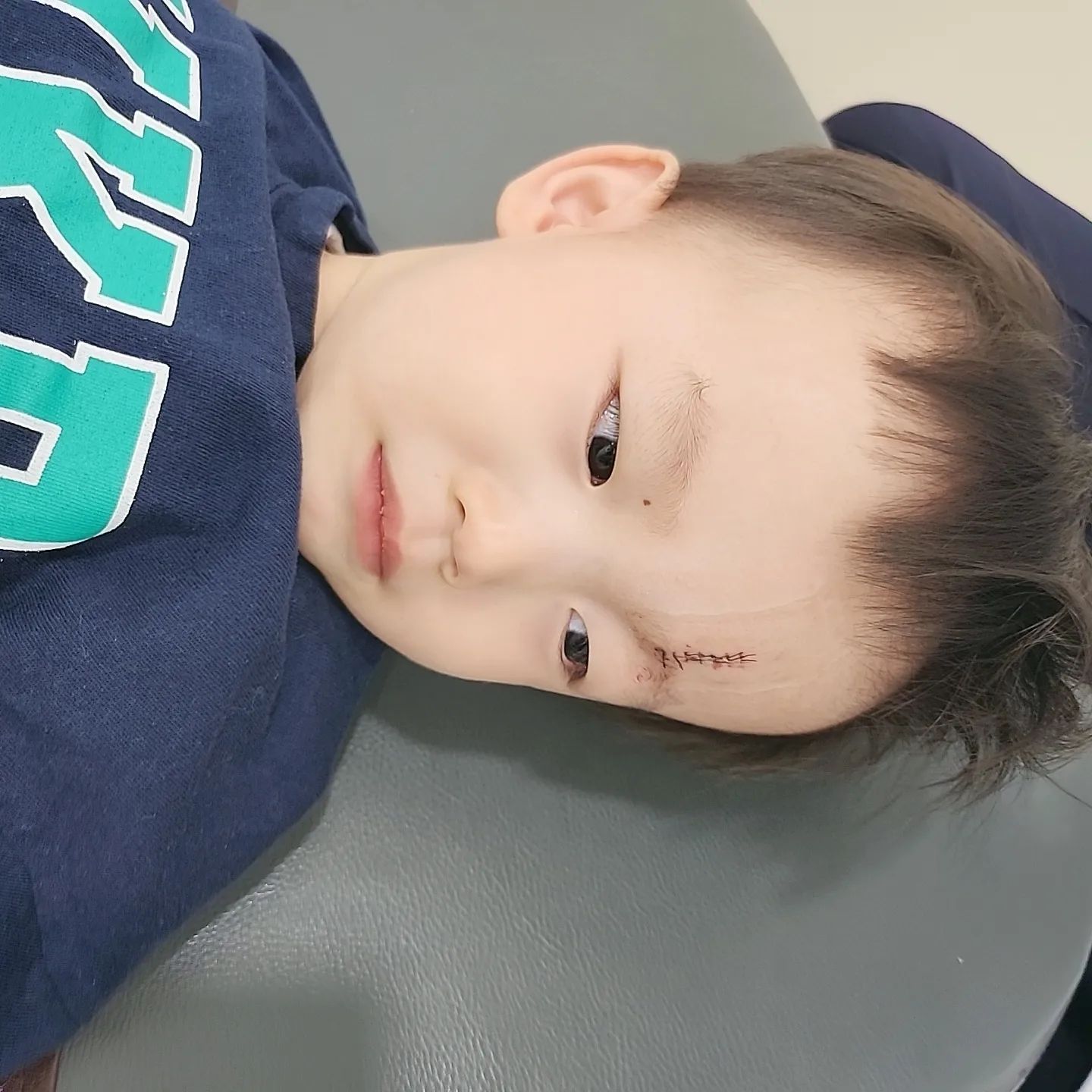 땡그리제우가 다쳤어요😭
정말순식간이였지뭐에요
안방으로 뛰어가다가
 문테두리에 팅박고 튕겨져나오는데
갑자기 살이쫙찢어지더니 피가철철..
머릿속이 하얘지면서 아무생각도안나더라구요

다행히 남편오는시간이라 바로 근처대학병원 응급실로갔는데 성형외과의사가 없다며
 119에 전화해서 다시 확인했더니
다행히 20분거리 대학병원에 확인이되서
바로갔는데 이번엔 애기라 수면마취 후 꼬매야하는데 병상이없어서 기다리라는말과 2시간대기했답니다..ㅠㅠ
그리고 겨우 들어가서 씨티찍고 또 1시간대기 
3시간만에 수면마취를했는데 억지로재워서
그런지 눈도 반만감은채로 꼬맸어요ㅠㅠ

근데 바늘이들어가니 움찔하더니 반만 뜬 
눈사이로 또르르 눈물이흐르는데 더이상은못보겠어서 고개돌리고 같이 울어버렸답니다😭

다음날 방문테두리 모서리방지용사서 남편이랑 집전체를 씌워버렸지뭐에요

상처가깊어 흉터치료 하라하셔서
성형외과알아보고있는데
우리땡그리 흉안지게 같이 기도해주세요🙏