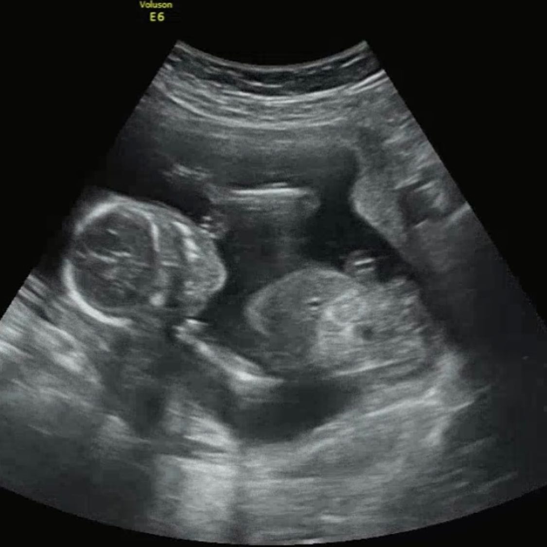 #16w2d👶🏻
2주만에 만난 엄마 아빠한테
까꿍하는 아기천사 👼🏻

초기부터 이상하게 배에 손 올릴 때마다
공주, 공주 소리가 절로 나오더니
모두의 예상을 깨고 딸램방구 확정 🤭

아빠는 벌써 제대로 보이지도 않는 얼굴
예쁘게 생겼다고 난리란다 🥹

튼튼히 자라서 열달 꽉 채우고
건강하게 만나자 🫶🏻