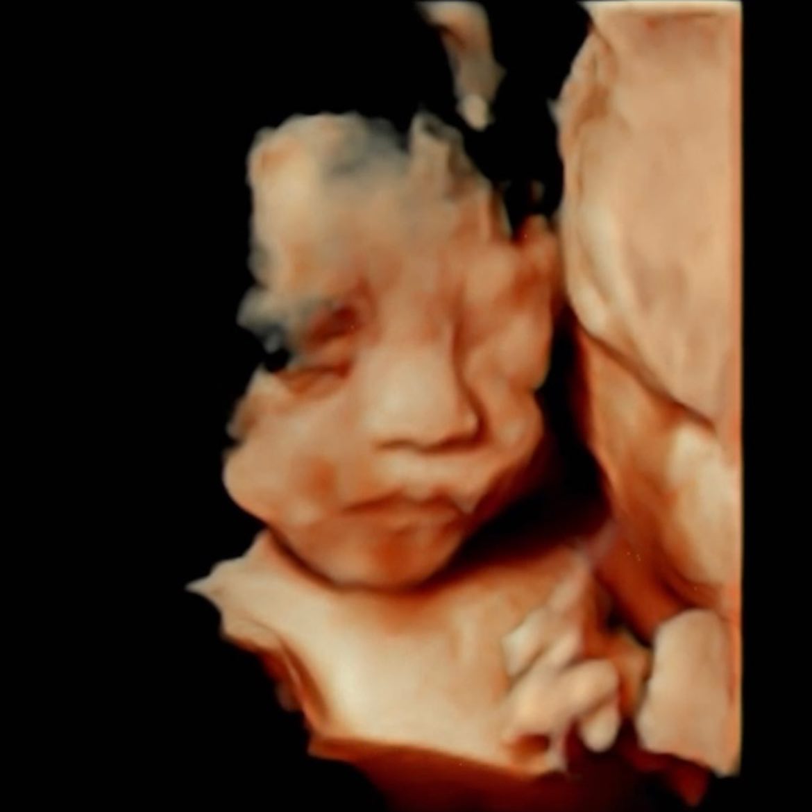 #25w0d👶🏻
입술은 그냥 누가봐도 아빠 쏙 빼닮은 신비띵👼🏻
코는,, 엄마 어릴때랑 쏙이네 ㅎㅎ
콧대,, 열심히 세워줄게 🥺

태동이 너무 잦고 심해서
내가 느끼는게 태동이 맞나 싶을때가 많았는데
얼마나 움직여대는지 의사선생님도 혀를 내두를 정도 
엄마가 느끼는 태동이 참이었구나,,🧐

자꾸 엄빠가 들여다보는게 귀찮았는지
얼굴 찡긋찡긋 거리더니 끝내 등을 돌려버리는🤣

신비야, 이번에도 건강하게 쑥쑥 자라줘서 고마왕 🧡