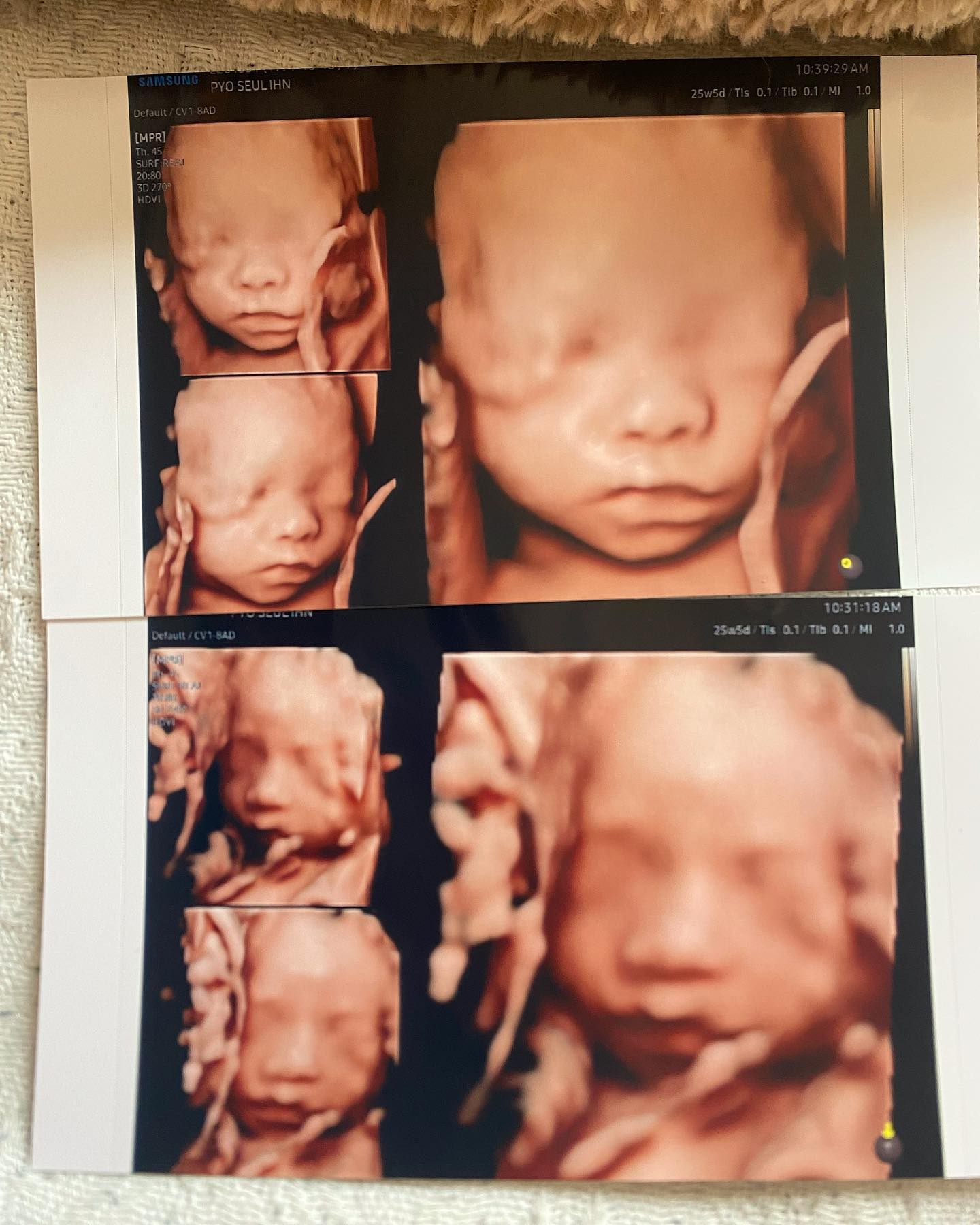 25W+6D❤️
아들 딸 남매둥이 입체초음파
아들내미가 아빠랑 똑닮아서 너무 신기해요

지인 말로는 입초 얼굴이 생각보다 태어나면 아이 얼굴이랑 닮았다해서 자꾸 보게 되네용☺️ 아이뽀...❤

#임신기록 #입체초음파 #남매둥이 #임신25주 #임신중기