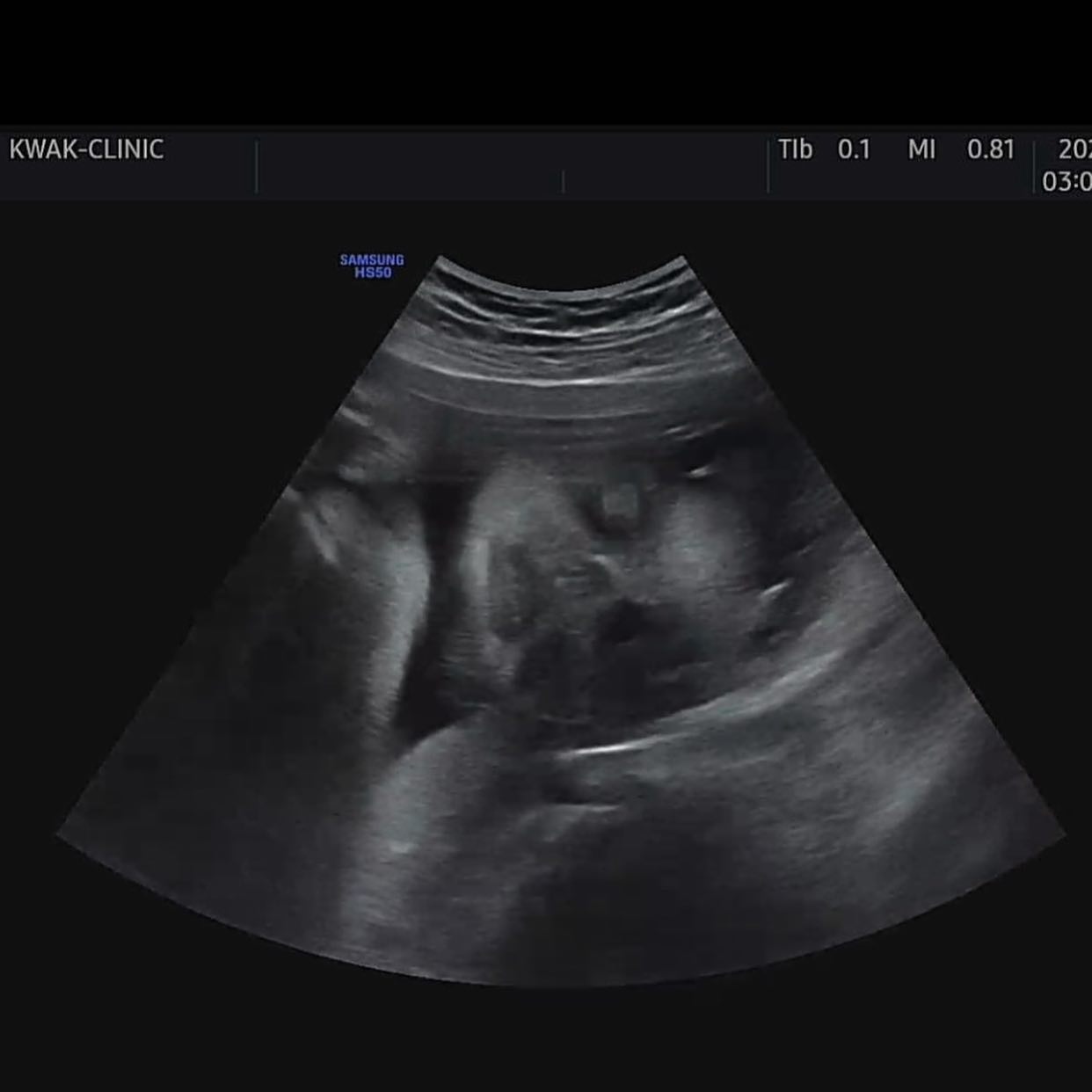 _
1.7kg이 된 우리 떵이🐮👶🏻
갈때마다 일주일 정도 앞선 크기의 떵이랑
갈때마다 쑥쑥 올라 몸무게 재기 무서운 엄마

쌤이 맵짠 고칼로리 피자, 라면등 자제하라고 하시다가
차트보시고는 제왕이니 그냥 편하게 하라며ㅋㅋㅋ
요즘 내 최애음식이 진짬뽕이라 뜨끔했...🥲
에라 모르겠다 살은 방빼고 걱정할란다

오늘부로 30주 진입!!!
말이 70일이지 두달후면 만나겠네 우리 아들ㅋㅋ
아들이란 말이 왜이렇게 어색한지 모르것네ㅋㅋㅋ

초음파로 보이는 얼굴이 너무 빵떡이라 걱정했더니
경환이가 아들은 엄마 닮는다며ㅋㅋㅋㅋㅋ
그래 빵떡이어도 내눈엔 귀엽겠지 모
.
.
.
#예비소띠맘#임신8개월#30주진입#만삭임산부
#복떵이#초음파사진#빵떡이#아들맘
#건강하게만자라다오