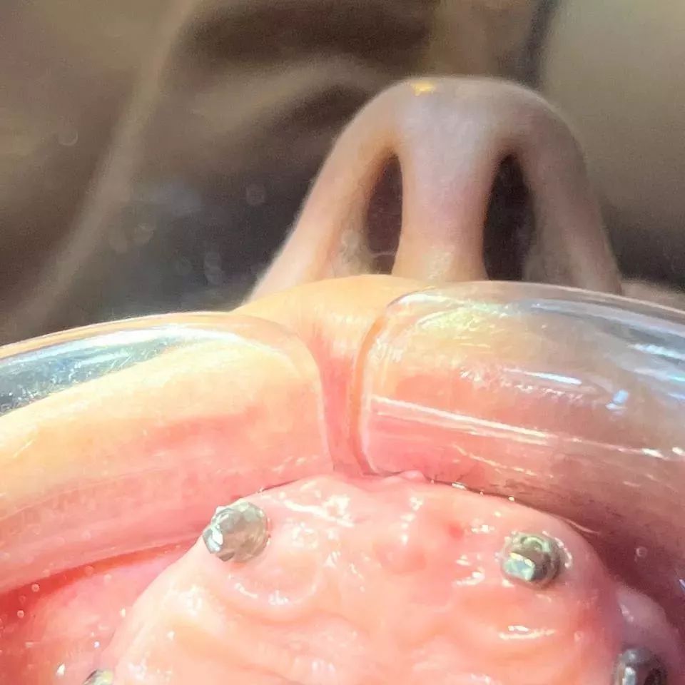 Full arch ceramic Implants❤
تم العمل في المختبر التقني الحديث 
لكل من المبدعين :- 
الدكتور محمد عبد المنعم
والدكتوره هديل 
اوقات الدوام من الساعه العاشره صباحا إلى الساعه العاشره مساءا 
موقع المختبر :- بغداد حي الجامعه مقابل الكوخ 
للتواصل دايركت أو الاتصال على الأرقام 
Dt:- MOHAMMED SABAH 
+964 773 204 1987
DT:- sajadjooda 07814154025
#emax #f #workout #wax #streetstyle #zircônias #dental #dentist #art #artist #dubai #sopa #zircônias #veeners #