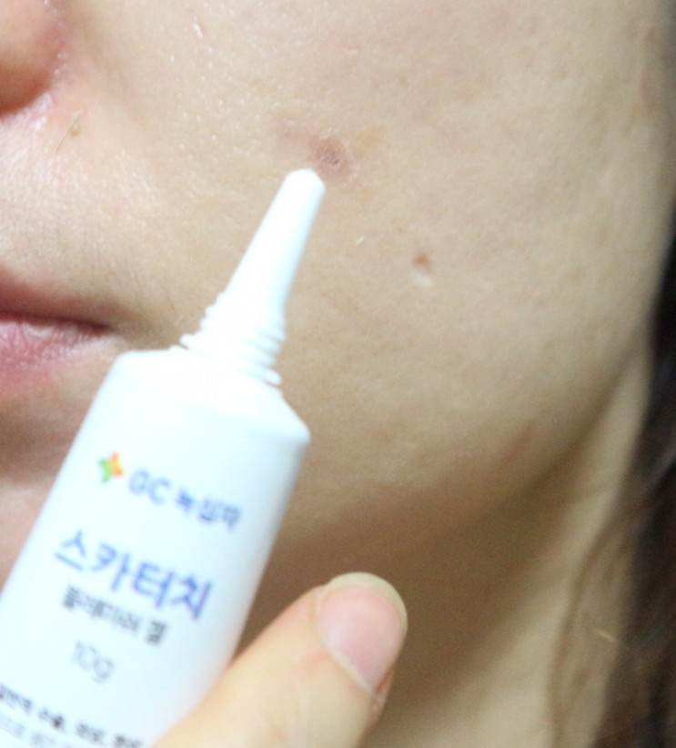 여드름 흉터제거에 좋은 스카터치블레미쉬겔로 흉터관리해요