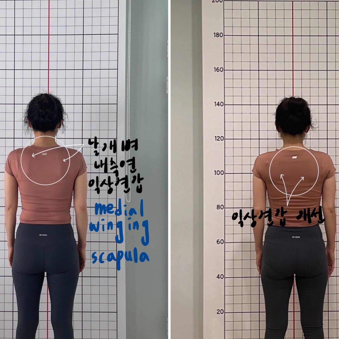 ✨ #통증감소 를 위해서 #필라테스 를 등록하신 회원님 

✔️ 40분 이상 걷거나 자다 일어나면 허리가 뻐근하신 회원님이 #통증완화 를 위해 #기구필라테스 를 등록했습니다 

✔️ 골반 가동성(움직임)의 제한이 있어 골반을 움직이는 방법과 아랫배, 둔근을 사용하는 느낌을 전혀 인지하지 못하셨습니다

✔️ 기본적인 #통증관리 를 위해서 바로 누운 자세에서 가장 기본적인 골반 움직임에 대해 인지 시켜드렸습니다 (골반 중립, 후방 경사, 전방 경사)
그중 후방 경사의 움직임이 가장 제한되어 있으셨기 때문에
짐볼 위에서 골반 움직임 연습, 다양한 포지션(바로 누운 자세, 엎드려누운 자세, 네발 기기 자세, 두 발기기 자세)에서 골반 움직임 연습, 후방 경사에서 #브릿지 까지 연결하는 방법을 사용하여 후방 경사의 움직임과 골반을 안정적으로 잡아줄 수 있는 #근력강화 를 하였습니다

✔️ 주 3회씩 30회를 하신 회원님은 어떤 결과를 만들었을까요?

👆👆 위에 있는 회원님의 사진을 한 번 보세요 회전되어 있던 골반뿐만 아니라
다른 #체형불균형 있던 부분까지 같이 #체형교정운동 하여 30회만의 좋은 변화를 이끌어 내었습니다 

✔ #체형교정 하며 #다이어트효과 도 보셔서 같은 옷을 입고 있으심에도 불구하고 개선 후에 옷 주름이 더 보이는 것으로 보아 전체적으로 라인 정리가 됐다는 것도 볼 수 있습니다