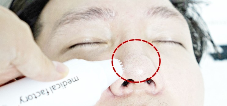 메디컬팩토리 피지제거기로 블랙헤드 뽑는 생생 후기