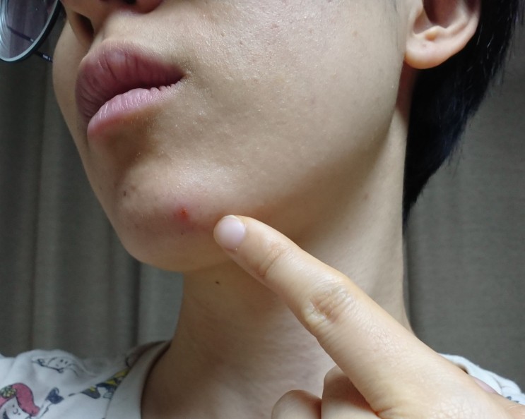 판토텐산, 여드름 치료 되는 원리부터 알아야한다? 효과/원리/고르는법