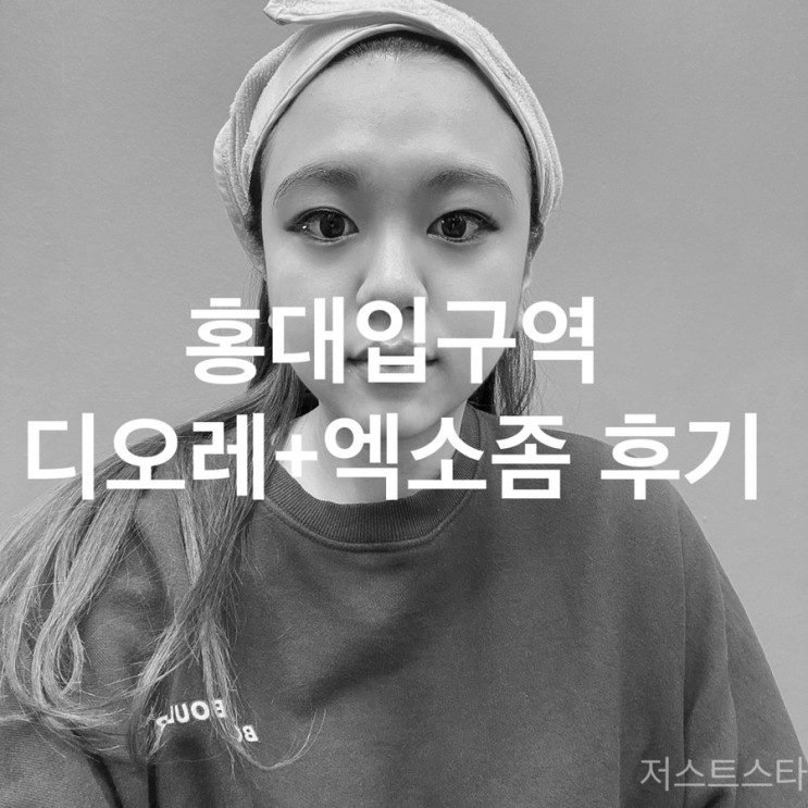 홍대입구역피부과 디오레듀얼(아기레이저) + 엑소좀 후기!