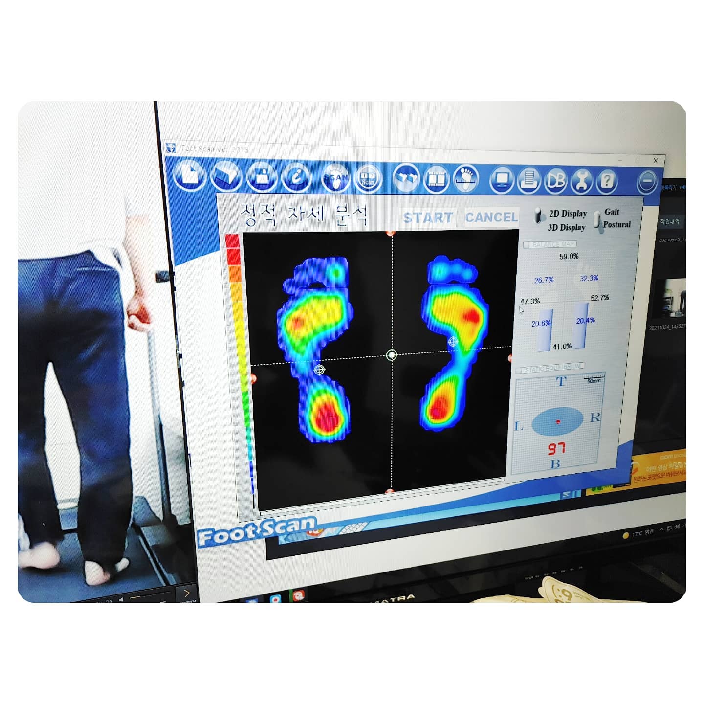 #발검사 #발건강 #족저압검사 
#평발 #자세교정  #와카남 #발통증