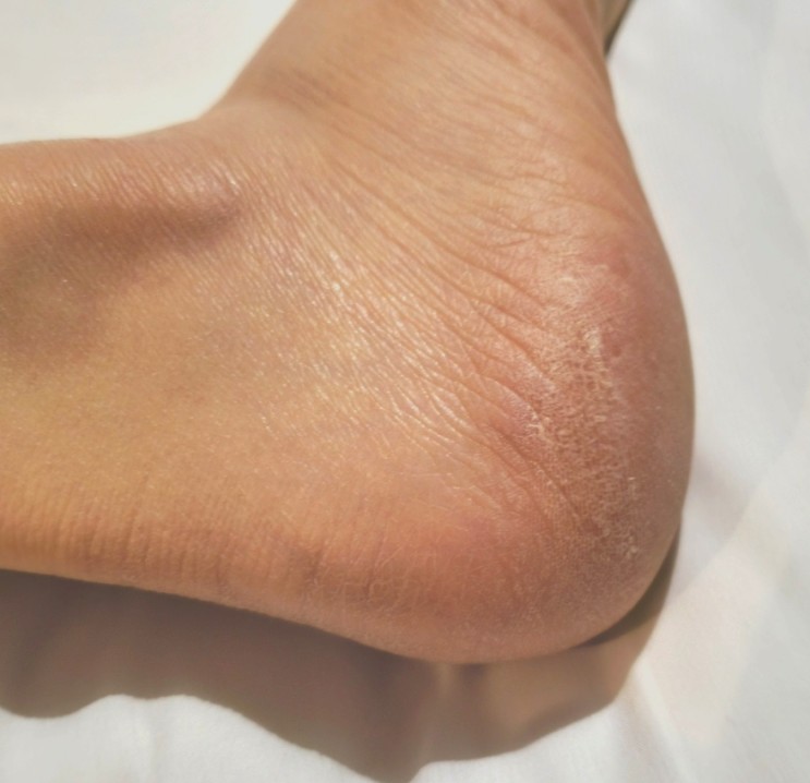 풋케어) 발각질관리 발뒷꿈치각질제거 풋로직스