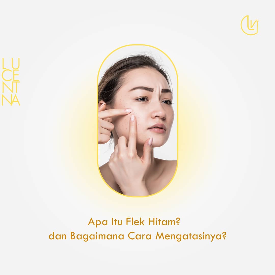 Freckles atau flek hitam adalah salah satu problem banyak wanita di Indonesia. Flek hitam muncul karena adanya peningkatan produksi melanin di dalam kulit. 

Saat kulit menyerap sinar ultraviolet, produksi melanin akan meningkat. Bagian kulit yang memiliki banyak melanin inilah yang akan tampak lebih gelap dibandingkan area kulit sekitarnya. 

Secara umum, flek hitam memang tidak berbahaya untuk kulit. Meski demikian, beberapa orang memilih untuk menghilangkannya dengan skincare. Ini bisa dibilang pilihan yang tepat, tentu agar flek hitam tidak merusak penampilan Anda. 

Anda bisa menggunakan produk-produk dari Lucentna yang memiliki kandungan Tranexamic Acid tinggi. 

Tertarik untuk mencoba? Anda bisa berkonsultasi terlebih dahulu melalui linimasa kami atau chat di 081284529127. 

#lucentna #skincare #skincareset #serum #micellar #moisturizer #daycream #nightcream #skincareroutine #skincareindonesia #skincarebpom #tranexamicacid
#flekhitam #kulitglowing #wajahglowing #kulitcerah #melasma