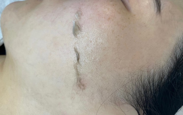 겨울철 화장빨은 여기에 올인한다... 나만 알고 싶은 더마 플래닝 솔직 후기!!!!!!! 서산 페이스왁싱 '루아래쉬'