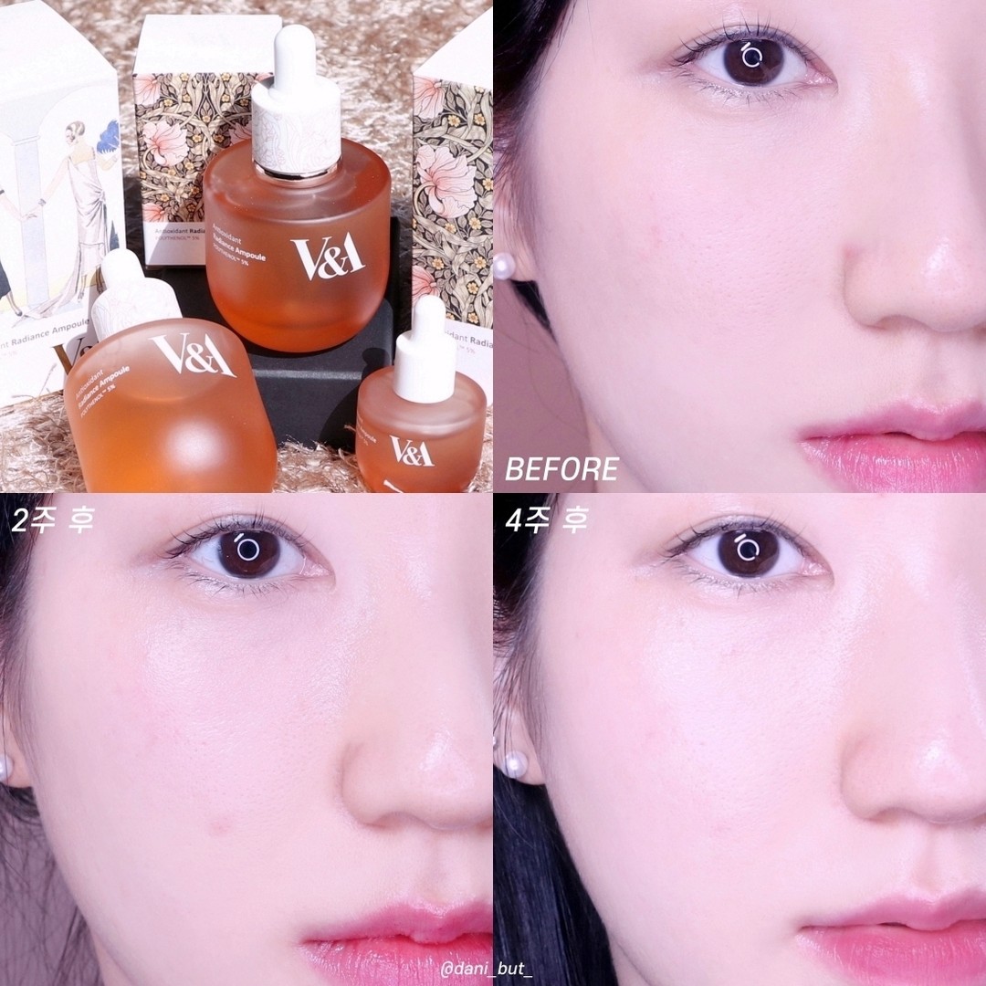 #제품제공 이지만 한달째 사용중인 #바르는항산화
vabeauty.official
한달 동안 꾸준히 사용해본 #브이앤에이
안티옥시던트 래디언스 앰플!
변화를 한눈에 볼 수 있게 B&A 모아봤어요:D
⠀
⠀
중간중간 피부 컨디션이 안 좋아서 너무 예민할 때
며칠 빼고는 매일매일 사용해줬어요!
⠀
전체적으로 한번 흡수시킨 후 기미잡티가 고민인 부위에
소량 덧발라 레이어링하거나, 앰플팩을 해줬어요
아무래도 고함량의 항산화 성분이 함유되어 있어서
자극이 되지 않게 앰플팩으로의 활용은 종종!
앰플 자체가 무겁지 않고 흡수력이 좋아서
레이어링해도 답답하지 않은 점이 좋았어요😀
⠀
눈에 보이는 겉기미와 속에서 생겨나는 속기미를
모두 케어해주는 강력한 #더블기미케어 앰플로
사용한 변화가 눈에 보여서 보람이 있네요ㅎㅎ
⠀
특히 콧볼 옆과 광대 부근의 #기미잡티 ,
1주차 때 생겼던 볼 아래쪽 큰 얼룩이
한층 투명해진 느낌이 만족스러워요-
⠀
⠀
남은 1달도 #브이앤에이앰플 열심히 사용해서
더 맑고 투명한 피부로 케어해볼게요🏃‍♀️🏃‍♀️
⠀
⠀
*소비자의 이해를 돕기위한 이미지로 개인차 있음
⠀
⠀
#안티옥시던트래디언스앰플 #파우더룸 #파루미언서 #스킨케어 #항산화앰플