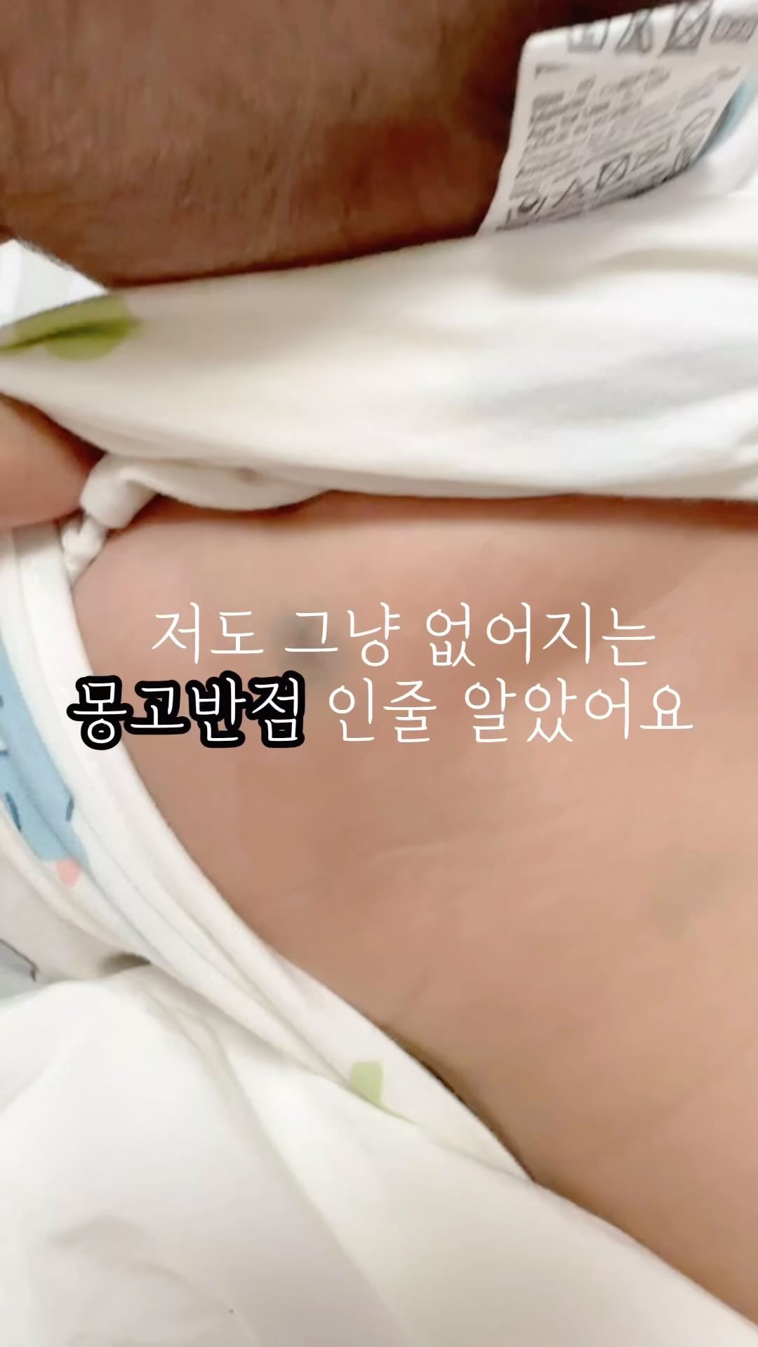 #이소성몽고반점치료 
로니 이마에 다들 아시는 밀크반점치료를 시작하며 알게된 로운이의 몽고반점! 저는 몽고반점은 당.연.히 없어지는지 알았어요.
그런데 아니라는거에요?????? 엉덩이는 보통 없어질가능성이 크지만 등 어깨 발목 등의 진한점은 없어지지않을 가능성이 크다더라구요.
그래서 두고보기에는 밀크반점처럼 치료시기가 늦을수록 더 잘 안빠지고 몸이커지면서 부위도 커질수 있다길래 로니는 치료를 시작했어요!

🎈비용
이러라고 태아보험을 들고 특약을 넣어둔건가봐요. 저는 로니가 태어나고 선천적 질환이없어서 특약을 뺄까 고민을하다가 뒀는데 이게 너무 다행인거였어요. 밀크반점은 미용상의 시술이라 레이저비용이 온전히 본인부담인데,
이소성몽고반점으로 진단을 받으면 선천성질환으로 보험금이 나와요!

그런데 이게 진단비가 매번 할때마다 30만원씩나오더라구요!(저는 ㅎㄷㅎㅅ인데 아기 태아 보험회사의 약관을 살펴보시면됩니다! 특약중에 첫 1회만지급으로 선택해서 매번못받는분도 봤어요ㅠㅠ) 

레이저가 수술로 포함이되어 이소성 몽고반점 진단비30만원과 실비70프로가 나와서 로운이 1회 진료비가 28만원일경우 70프로해당하는 196000+30만원진단비 이렇게 나와서 정말 부담없이 치료가 가능했어요ㅠㅠ

🎈통증
한달에한번이고 아직어려 부위가 엄청크지않아 우선 네군데를 먼저 치료하는데 시간이 몇초단위로 하다보니 마취크림하나바르고 시작해도 크게 울거나하지 않았어요. 근데 고출력이라 밀크반점 저출력레이저랑은 확실히 자극이 있는지 반응은 다르긴하더라구요! 아이가 어릴수록 치료도잘되는것 같아요! 큰아이들은 더 커진면적만큼 길어지니 아파하는아이도 있었어요ㅠㅠ 저는 로운이가 더 면적이커져서 더 힘들어지기전에 치료하길 너무 잘했다고 생각합니다!

🎈횟수
몽고반점은 보통 1회씩 경과를 봐가면서 진행하는것 같아요. 현재 4회정도 진행중인데 아직은 옅어지고있는것도있고 큰변화가 없는곳도 있어요.
보험안되는 밀크반점은 몽고반점이랑 달리 기본이 30회-100회하시는분들도 있던데 5개월에 일찍 시작한만큼 이번 10회차쯤되니 진짜 많이 연해져서 너무 만족하고있어요! 첨엔 효과가있나싶고 너무 빨리끝내서 돈아깝다 싶었는데 아기가 크게힘들어하지않다보니 멀리 차타고 다니길 너무 잘했단 생각만 들어요. 

처음엔 내욕심으로 너무 어릴때 레이저를하는가 싶기도해서 고민했지만 누구라도 내얼굴에 큰점이있거나 몸 보이는부위에 큰점이있다면 일상에서 편하게 다니기다 쉽지않기에 저는 지금 해준것에 후회도없고 그건 부모각자의 판단과 선택인듯 해요! 혹시나 비용때문이나 저처럼 정보모르고 놓치는분이 있을거같아 올려보아요🫶🏻

🎈로니의 치료
로니는 5개월부터 밀크반점은 매주, 몽고반점은 매달 이렇게 다니고 있어요.
밀크는 10회만에 거의 옅어졌고 진한고 잘안빠지는 점이었는데 어릴때 빨리간게 큰 효과를 본듯해요. 몽고는 많이 옅어지는 중이고 가장 진하고 노출이 쉬운 곳 네곳을 먼저하는중이에요. 의사선생님이 알아서 이건좀더 지켜보자, 이건 지금해야한다고 상담하며 알려주세요. 

🎈서류
서류는 병원에서 진단서(만원) 세부내역서 영수증 이렇게 발급해준거 보험회사 제출해서 받았습니다! 자세한건 아기태아보험 약관에 특약사항이랑 설계사분통해 상담받아보시면 될거같아요🥹

🎈병원
저는 카페에서 찾아 대구 ㅇㅍ 로 갔는데 서울에도 어디든 지역별로 유명한곳이 있는것 같았어요! 선천성모반카페 가입해서 찾아보심 될것깉아요!

별개로 정보하나 더하자면 밀크반점 수술을 절개로 하는경우도 있더라구요. 그만큼 잘 안없어지는 점이라는건데 저는 이마부분을 절개해서없애기가 너무 부담스럽고 최대한 피하고싶고 하게되면 그건 로운이가 커서 의사를 물어보고 해줄계획이었는데 다행히 레이저치료가 효과있는중이라 괜찮을거같아요! 

꼭 혜택을 받을수있다면 받으시길바래요💓