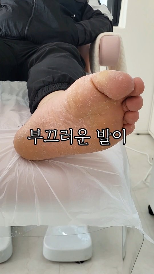 울산 문제성발관리 패디웰
@pediwell_ 

신랑이 묵은 고민이자 고생의 발
본인도 많이 걱정스러우면서도 부끄러워했던 발
이제 그 고민 날려버리자‼️‼️‼️‼️
신랑의 발은 당장 1회성으로는 힘들지만
그 1회만으로도 드라마틱한 효과를 봐서 
원장님이 알려주신 방법를 다 총원 중인 신랑.
피부과가서 피부과약도 처방받고 풋샴푸도 구매하고
이제 우리 조금씩 깨끗해지는 발을 가져보자🦶🏻

발의 관리도 엄청 중요합니다. 발을 깨끗하게 관리하는 것은 감염예방, 냄새제어, 피부 건강 유지 및 편안한을 유지하는데 도움이 된다구요! 신랑도 털어내고 걸으니 침대 위를 걷는 것 같이 좋다고 하더라구요!

부끄러운게 아닌 빨리 찾아가 꾸준한 발관리를 통해 건강한 발을 유지해보도록해요. 신랑 뿐만 아니라 친정 아버지, 시아버지 등 발을 한 번 확인해보세요🤧 그리고 건강을 찾아줍시다. 

#울산문제성발관리 #패디웰 #무좀 #울산발관리 #울산패디웰