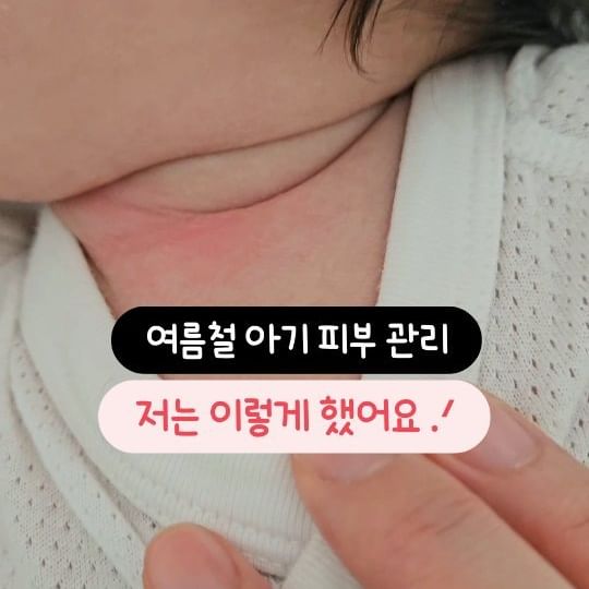 👇🏻다가오는 여름철을 대비해서 저장해놓고 보세요✔️

생후 1~3개월에는 땀구멍이 발달하고
신진대사가 활발해지는 시기인데요!
그만큼 땀을 많이 흘리기 때문에 땀띠가 쉽게 생기죠..🫠
땀띠가 생기면 보기에도 속상할 뿐만 아니라 아이도 불편함을
느낄 수 있어서 엄청 신경쓰이지 않나요? ㅠㅠ

주로 얼굴, 목, 가슴, 겨드랑이 등에 나타나는데요.
저희처럼 옆잠베개를 쓰면 더 심하게 나타나더라고요....
아직 한여름도 아닌데 벌써부터 땀띠로 고생해서
여름철 아기 피부 관리법을 찾아보고 관리해주고 있어요🔥

✅️ 땀띠 관리법
1. 메쉬 소재로 된 반팔, 민소매를 입힌다.
(유니클로, 탑텐, 베이비붐 등)

2. 땀을 흘렸을 땐 바로 거즈수건으로 닦아준다.
(수시로 확인할 수 없어서 사실상 불가능)

3. 하루 3번 이상 수딩젤과 땀띠크림으로 관리.
(냉장고에 넣어두고 시원하게 쓰면 더 좋아요)

✅️ 되도록이면 옆잠베개도 안 쓰는 것이 좋다고 하는데요.
듀라론 소재로 돼있어도 애기가 자고 일어나면
후끈후끈 하긴 하더라고요 ㅠㅠ 그래도 저흰 아직 놓지못해서😂
열심히 수딩+땀띠크림으로 관리해주고 있어요.

✅️ 통풍 잘 되는 메쉬 반팔도 필수!!
유니클로보단 베이비붐 반팔슈트가 품이 널널해서
통풍이 잘 되더라고요. 할인할때 무배로 샀어요(할인 자주함)

⁉️ 그리고 옛날에는 파우더를 발라서 관리해줬잖아요?
파우더에 들어있는 화학물질이 오히려 아이의 피부를
자극할 수 있고, 호흡기로 들어갈 수 있어서 비추천한다고 합니다.

✅️ 대신 저는 땀띠크림으로 파우더크림을 쓰고 있고요 .ᐟ
크림처럼 보이는데 바르면 파우더처럼 되더라고요.
그래서 가루날림이 없이 뽀송뽀송해요✨️
땀띠크림은 나뚜라하우스 꾸찌올로크림이 유명한거 아시죠?
저는 협찬받아서 사용중인데 꾸준히 써보고 재구매하려고요😎

❤️아이방 적정 온도는 22~24도, 습도는 50~60%로
맞춰주는 것이 가장 Best 입니다❤️

✨️아기들은 생각보다 땀띠가 쉽게 생기기 때문에
✨️미리 저장해놓고 꼭 관리해주세요.
✨️육아동지 @태그, 공유 해서 같이 알아두면 더욱 좋겠죠?

#기저귀발진 #땀띠 #땀띠크림 #신생아로션 #신생아로션추천
#아기로션추천 #육아템추천 #크림추천#나뚜라하우스#육아정보
🙏🏻 협찬제공 @natura_house_kr
