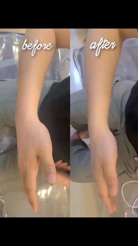 손목, 어깨 통증 감마앰플 케어 전 후, 

우리 신체는 미네랄이 부족하면 손 저림, 입 마름, 손톱이 잘 부러짐, 혹이 잘 생김, 만성 피로, 불면, 기립
저혈압, 생리통, 스트레스, 가려움증 등등 을 동반하게 되는데 

감마앰플의 주요 성분은 미네랄로 되어있어, 
통증 및 염증케어에 도움을 줍니다.(원료적 성분에 한함)✌️감마앰플이 궁금하신 분들은 DM 또는 댓글로 문의 주세요!

@dr_hayyim_sns
@dr.hayyim_director

#감마앰플
#닥터하임
#바디컨디셔닝
#통증케어
#미네랄