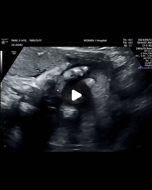 용복이 하잉~🙋🏻‍♀️
인사해주는 공주님,,🩷
벌써 3kg 👶🏻
막달 검사도 다하고,,
가진통도 심해지고,, 곧 보자