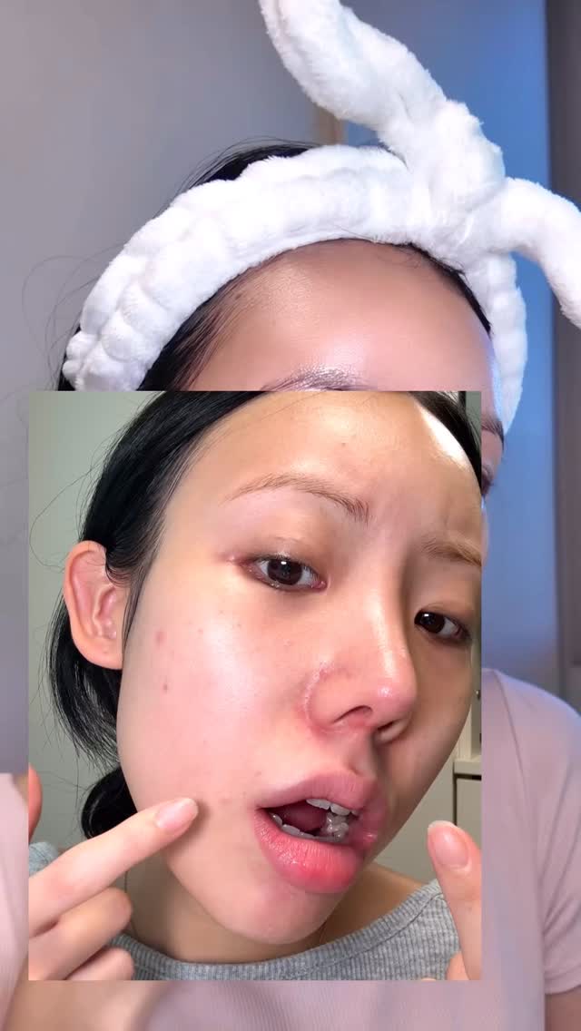 더이상 요철, 각질 방치그만❌ 오돌토돌 피부결 탈출하자!
💙닥터딥 ABP 요철 스팟크림@dr.deep.official
✔️오돌토돌 돌요철 피부결
✔️들뜨는 피부 각질,
✔️얼룩덜룩 색소침착
요철의 주 원인, 각질 탈락 주기를 개선하는 핵심 성분으로 피부결을 단 1회 만에 리셋!
무려 전국 약국 입점한! 이미 소문난 제품으로, 단 1회사용만으로 요철(피부결) 개선 임상 완료까지한 미네랄 보습 필링👍
고농도 미네랄 이온수인 Hyper-Mineral™ WATER 와AHA&PHA 최적의 배합으로 피부결이 진짜 보들보들해지더라구요!
나이아신아마이드 함유로 기미, 잡티 미백은 물론이고,
프로폴리스추출물 함유로 항균, 항염 효과까쥐..✨
진정 complex (병풀+어성초추출물) 함유로 달아오른 예민한 피부진정에도 효과적이라 매일매일 발라주기도 좋아요!
무엇보다 피부 자극도 0.00%로 민감성피부인 저도 전혀 자극없이 순하게 안심하고 사용중!
지금 공식몰에서만 1+1 특가 할인중이니 꼭 구경해보기 🙂
요즘 요철 신경쓰일때마다 닥터딥 요철 스팟크림으로 관리해 주었더니,
요철 없는 매끈 도자기 피부로 변한거 있죠!?🤎
요철 고민이라면 닥터딥 요철크림 하나로 해결해보세요!✨
#닥터딥 #drdeep #스팟크림 #요철케어 #피부결개선 #셀프케어 #kbeauty #바르는_필링크림#kbeauty #kskin #요철크림 #요철없애는법 #요철없애기 #각질개선 #각질케어 #각질제거 #각질크림 #환절기크림 #환절기 #환절기필수템 #각질관리