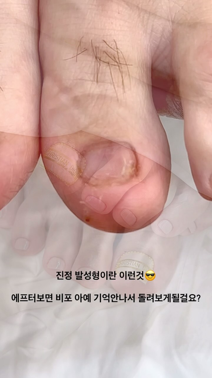 〔 패디엄지연장 〕
• 𝗽𝗿𝗶𝗰𝗲 𝟭𝟮𝟬,𝟬𝟬𝟬
⠀
#문제성발톱 으로 컴플렉스가 있으셨던 우리 고객님, !!
이제 당당하게 어디서든 양말벗구 다니세오😎
옌네일은 모든 문제성손톱, 문제성발톱을 건강하게 시술해드립니다
더이상 고민말고 옌네일로 달려오세요 🏃🏻‍♀️💨 ,,!!
⠀
• 풀연장 회원가 𝟴𝟬,𝟬𝟬𝟬 / 비회원가 𝟭𝟬𝟬,𝟬𝟬𝟬
⠀
특가이벤트는 스토리로 업로드됩니다 , 팔로우 해두시고 특가이벤트 꼭 챙겨가세요 ༉‧
⠀
⠀
예약문의 ‧ 수강문의 ⤵
❛ 프로필하단 링크 𝗖𝗹𝗶𝗰𝗸 ༉‧₊˚
⠀
예약하시기전 스토리 하이라이트 필독 부탁드립니다 ‧｡🐾*.+ﾟ