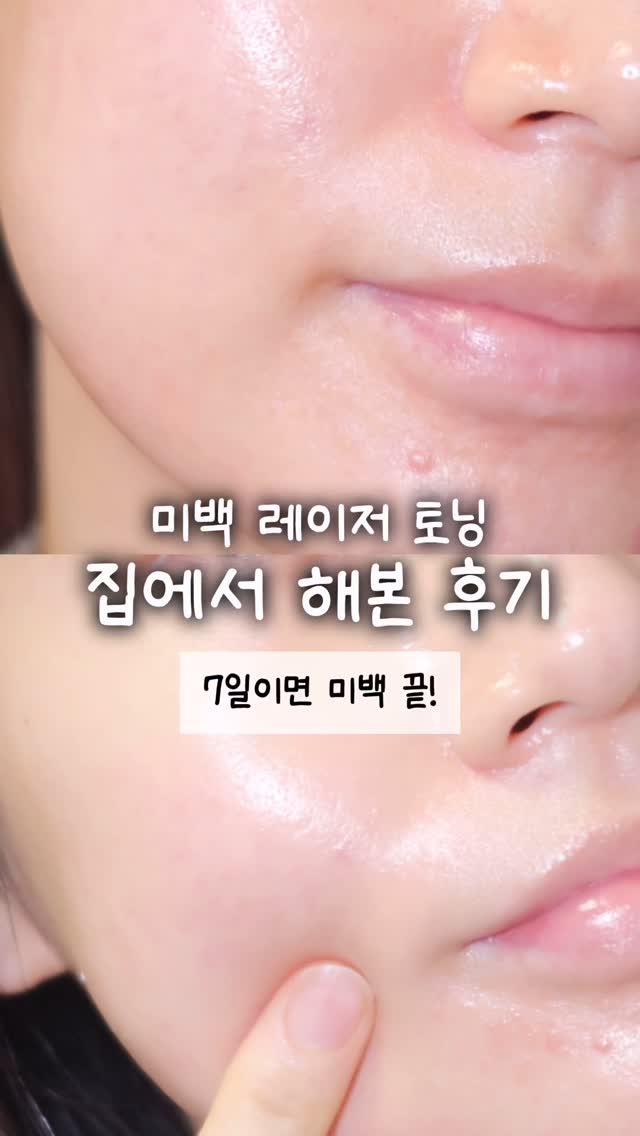 #광고 피부과 레이저 토닝 대신 이걸로 효과봤어요‼️
피부미백, 잡티관리 집에서 확실하게 하고싶다면 주목~~

칙칙하고 잡티로 걱정이던 피부에 바르는 레이저 앰플 하나로 피부과 뺨치는 비타민 레이저 토닝 효과를 볼 수 있더라구요?!

@athe.official 멜레이저 7일 프로그래밍 앰플
💛순수 비타민 C 30%, 나이아신아마이드 12%를 그대로 건조한 노랑색 비타민볼과
🤍MTS 원리를 담아 스피큘이 들어있는 앰플이 만나서
피부과 비타민 레이저 토닝을 집에서 바르는 관리로 할 수 있게 해주는 간단하지만 확실한 효과!

특히 전 피부과 MTS 시술 통증이 무서워서 못해봤는데
앰플에 들어있는 스피큘로 집에서도 편하게 통증걱정 없이 관리 할 수 있는게 넘 좋더라구용?!😮

일주일정도 꾸준히 아침, 저녁 발라줬는데 사용할수록 피부 톤도 맑아지면서 트러블로 생긴 어두운 잡티가 많이 개선됨..🫢❤️

육퇴 후 나갈 시간 없는거..저만 그런거 아니져🥲
아떼 공식몰에서 오늘부터! 2월 9일까지 최대 38% 할인율로 부담 없는 가격으로 피부과 대신 집에서 관리해요✨

#아떼 #멜레이저앰플 #바르는토닝레이저 #Mts #Mts앰플 #앰플 #미백