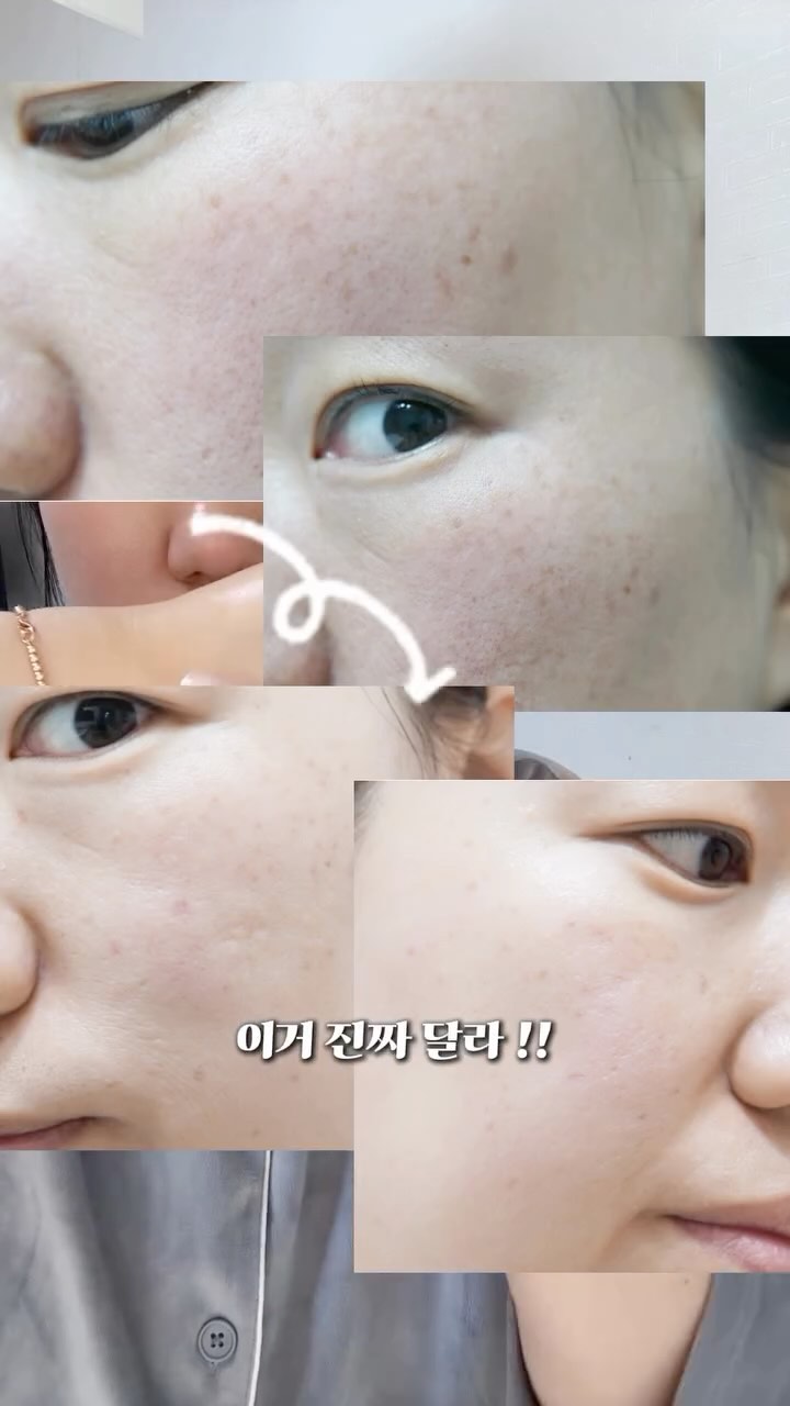 #광고 나 믿고 이거 써봐 
이게 내 얼굴이라고?놀래서 셀카를 찍었잖아

원래 화장으로 안 가려지는 깉은 기미와 잡티가 있었는데 
요즘 좀 달라졌어!!
이미 외국에서는 엄청 유명한 성분인데 
아는 사람들은 다 알더라구
기미 & 잡티 고민? 요즘 나 이걸로 케어 중! 

비에논 우레이드 세럼 2주 차 사용 중인데, 
거울 볼 때마다 너무 신나! 

✔ 눈가 기미, 색소침착 케어
✔ 스포이드 타입으로 위생적
✔ 부드럽게 발리고 흡수력도 빠름!
✔ 나이아신아마이드 + 우레이드로 자극 없이 미백 관리

화장으로도 안 가려지던 짙은 잡티도 옅어지더라
그러니까 고민만 하지 말고 기미 & 잡티 케어, 꾸준히 함께하자! 

#미백세럼 #기미잡티 #색소침착관리 #우레이드세럼 #스킨케어추천 #피부톤업