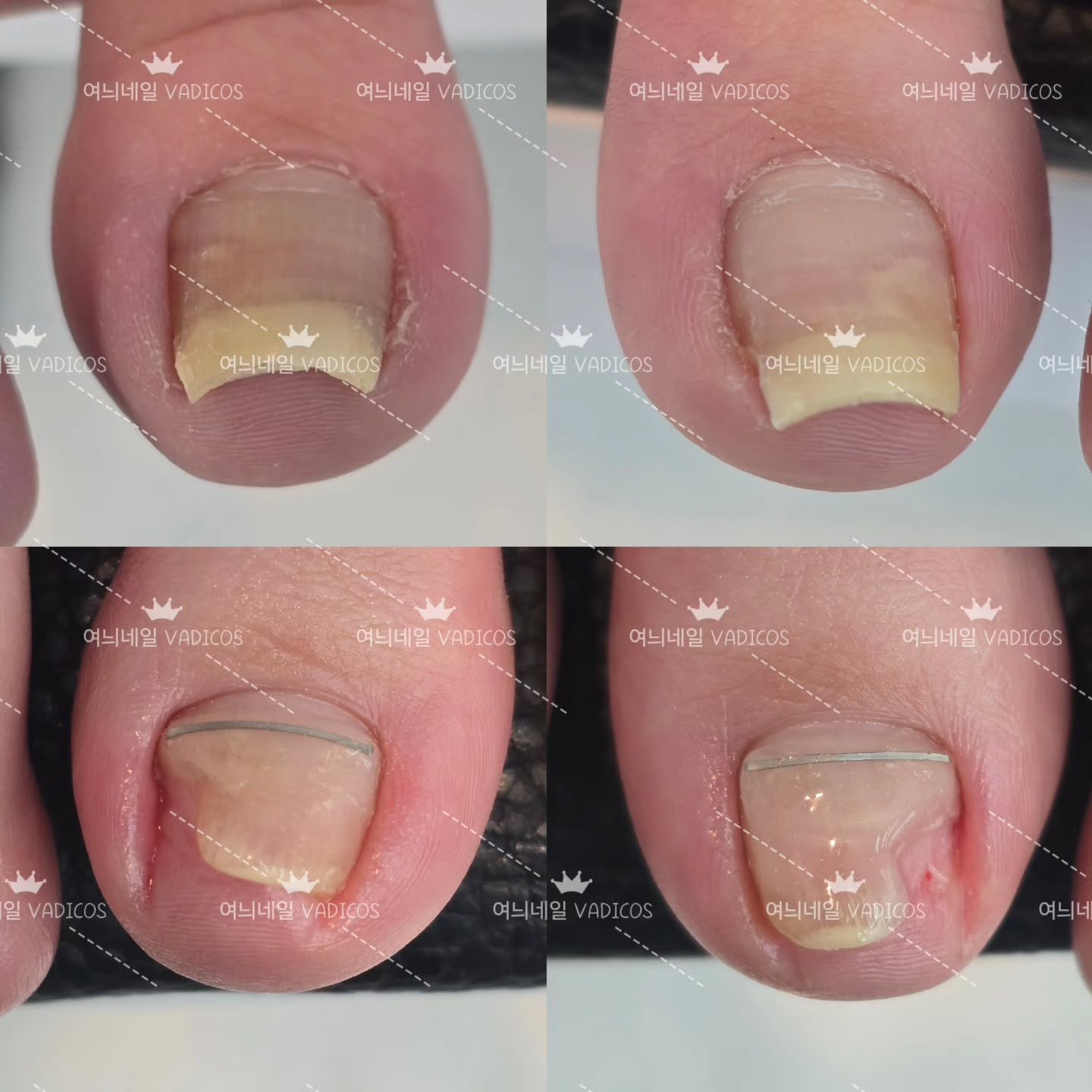 파고들고 박리되고 아픈발톱
오래 걸으시면 통증을 많이 느끼셨다는 고객님
여늬네일이 발편하게 해드릴께요^^♡

젤로띠끄로 표면 매끄러운 형상♡
사이드도 꽉채워서 으쌰 발톱올리기♡

항상 노력하는 여늬네일이 되겠습니다

월-금 10시~9시
토요일 10시~7시
네이버예약가능
010-2034-3256 문의주세요^^
시술시 전화나 문자는 답변이 늦어질수있습니다.
불편한 손발톱 이젠 감추지말고 관리받으세요^^
1:1 맞춤시술, 문제성손발톱, 짱짱한 유지력
여늬네일로 네일아트하러 오세요^^

👇👇여늬네일위치
경기도 남양주시 진접읍 봉현로32, 4층 여늬네일
장현 베스킨라빈스 건물 4층
장현 현대병원 도보 3분

#네일하는뇨자 #여늬 #여늬네일 #문제성손발톱 #네일맛집 #진접네일 #진접네일샵 #장현네일샵 #바디코스 #emi네일학원 #젤로랩 #젤연장 #젤랩핑 #바디코스 #젤로라인 #젤로띠끄