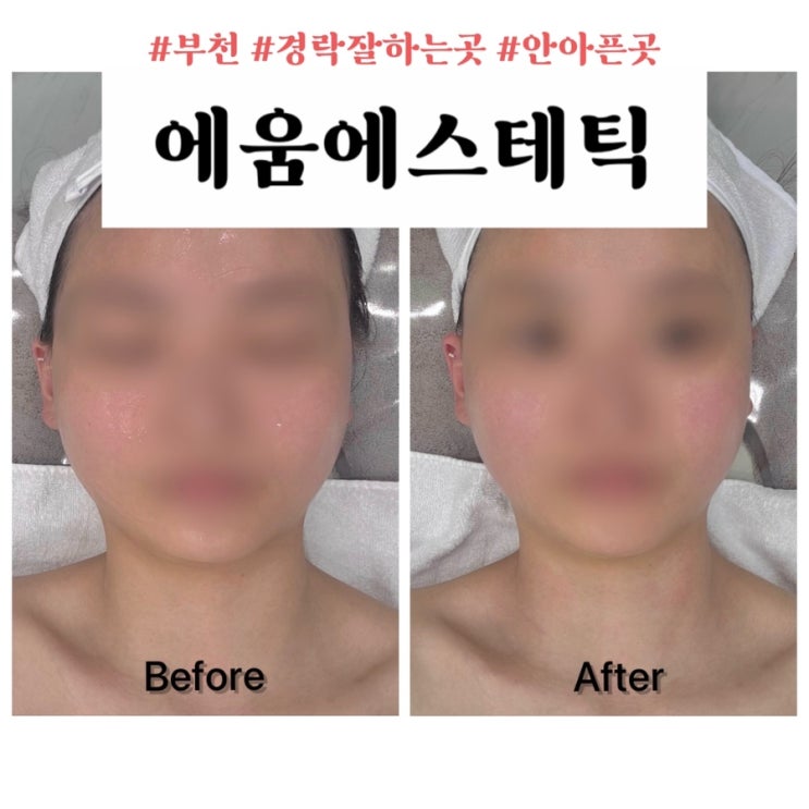 부천 옥길 피부관리 에움에스테틱 아프지 않은 윤곽관리 후기