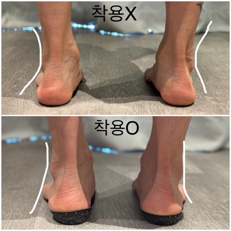 평발족저근막염치료깔창 오캄풋풋 찐후기