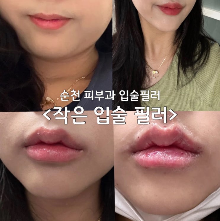 작은입술 필러 순천 피부과 필러&입꼬리 보톡스 2회차 후기(내돈내산)