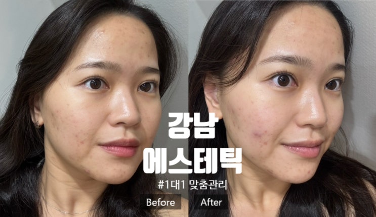 [삼성역] 내돈내산 효과 짱짱한! 1대1 맞춤 프리미엄 피부관리 삿에스떼 흉터관리 후기